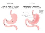 Dr. HE Obesity Clinic – Gastric Sleeve Surgery | Gastric Bypass