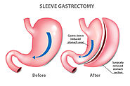 The honest truth about gastric sleeve surgery