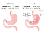 Gastric Sleeve Surgery in Phoenix, AZ | Agave Surgical Specialists