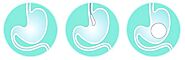 Intragastric Balloon Specialist - Beverly Hills Los Angeles, CA & Glendale, CA: Sergey Lyass, MD: Bariatric Surgeon