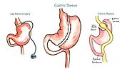 Sleeve Gastrectomy | A. Enrique Whittwell | Miami, Florida