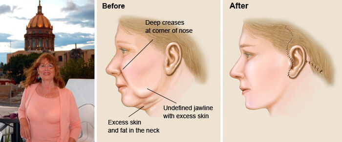 Face Lift Surgery In Mexico A Listly List