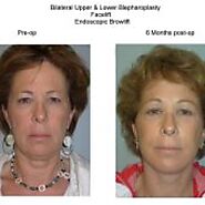 Face Lift / Neck Lift - Skinworks