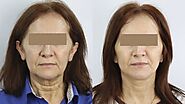 Thread Lift and Non-Surgical Face Lift in Vancouver