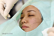 Silhouette Soft Thread Lift - Face Lift Without Surgery