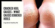 Cracked Heel Causes - What causes cracked Heels