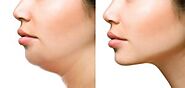 Face Lift Surgery Coimbatore | Face Augmentation Clinic | Face Plastic Surgery Hospital