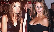 Melania Trump Plastic Surgery, Before and After Facelift Pictures - CELEBRITY