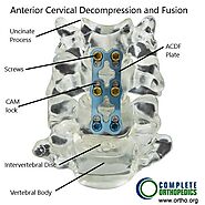Cervical Spine Fusion - Minimally Invasive | Complete Orthopedics