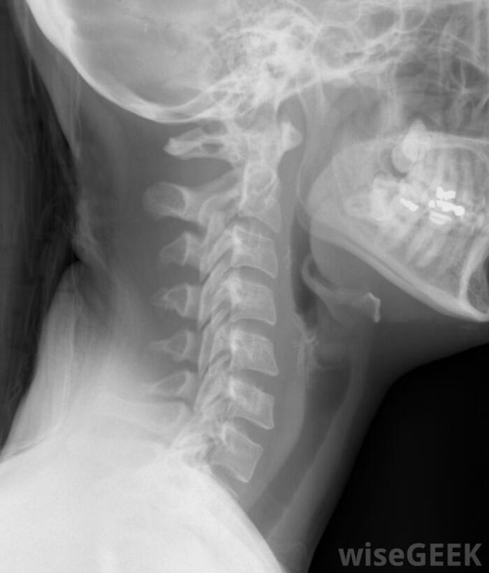Cervical Spine Fusion In Calgary | A Listly List