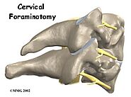 Physiotherapy in Calgary for Cervical Foraminotomy Surgery