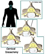 Surgery for Upper Back Pain physiotherapy in Calgary