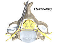 Foraminotomy Spine Surgery