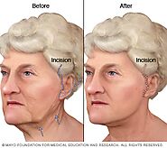 Estiramiento facial - Mayo Clinic
