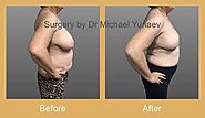 Breast Asymmetry Correction Sydney, More Affordable From $80/Week*
