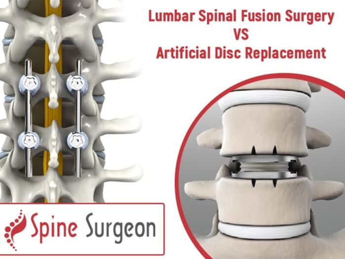 Spinal Disc Replacement Surgery In Calgary A Listly List