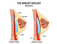 Breast Implants Sydney - Dr. Jeremy Hunt Plastic Surgery