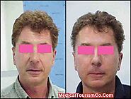 Facelift in Mexico | Rhytidectomy Cost