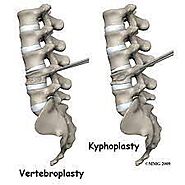 Kyphoplasty and Vertebroplasty