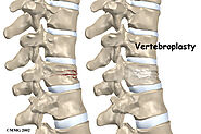 Vertebroplasty and Kyphoplasty Benefits Outweigh Risks?