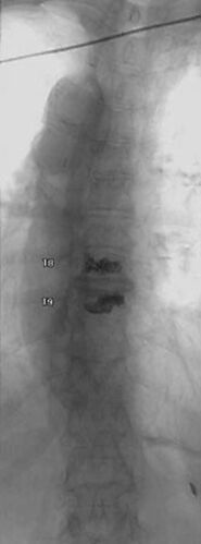 Vertebroplasty and Kyphoplasty