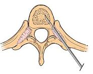 Vertebroplasty and kyphoplasty: filler materials - PubMed