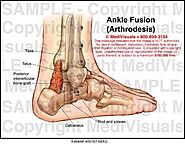 Joint Fusion Surgery | Arthritis Treatment, Surgery, Cost, Benefits, & Risks