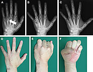 Physiotherapy in Calgary for Swan Neck Deformity of the Finger