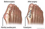 Joint Fusion Surgery In Calgary