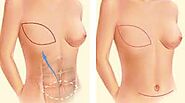 Website at https://pureaesthetics.com.au/procedures/breast/reconstructive-surgery/