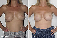 If you have had, or are about to have, breast surgery to treat cancer or another disease, you may have considered bre...