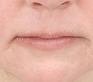 Lip Lift Surgery and Best surgeons in calgary