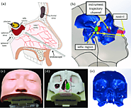 Endonasal Surgery in calgary