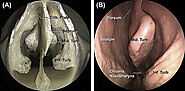 Endonasal Surgery in calgary