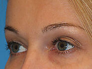 Eyebrow Lift Sydney | Non Surgical Eyebrow Lift Sydney | Shape Clinic