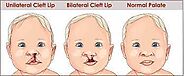 Website at https://www.schn.health.nsw.gov.au/find-a-service/health-medical-services/cleft-lip-and-palate/sch