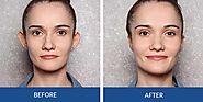 Otoplasty (Correction of Ear Shape Deformities) - Sydney Cosmetic & Plastic Surgery Clinic