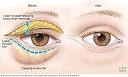 Eyelid Surgery Sydney - Blepharoplasty Surgeon & Specialist | Dr Shahidi