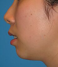 Facial Implants Sydney | Jaw And Facial Contouring | Shape Clinic