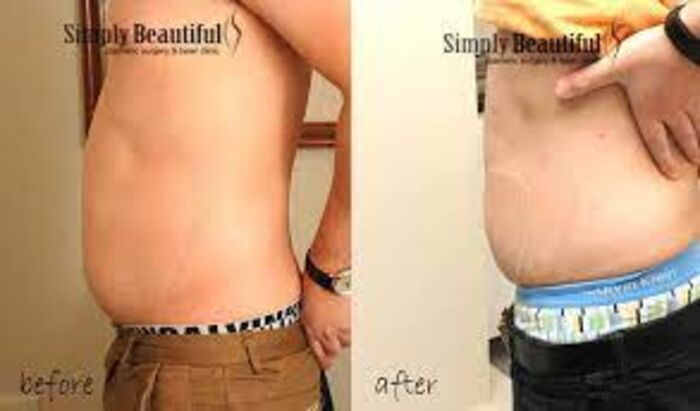 Fat Injection Sydney A Listly List Fat Injection Sydney A Listly List