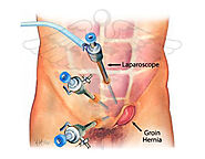 Laparoscopic Inguinal Hernia Repair