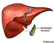 Gallbladder removal - open | Calgary Herald