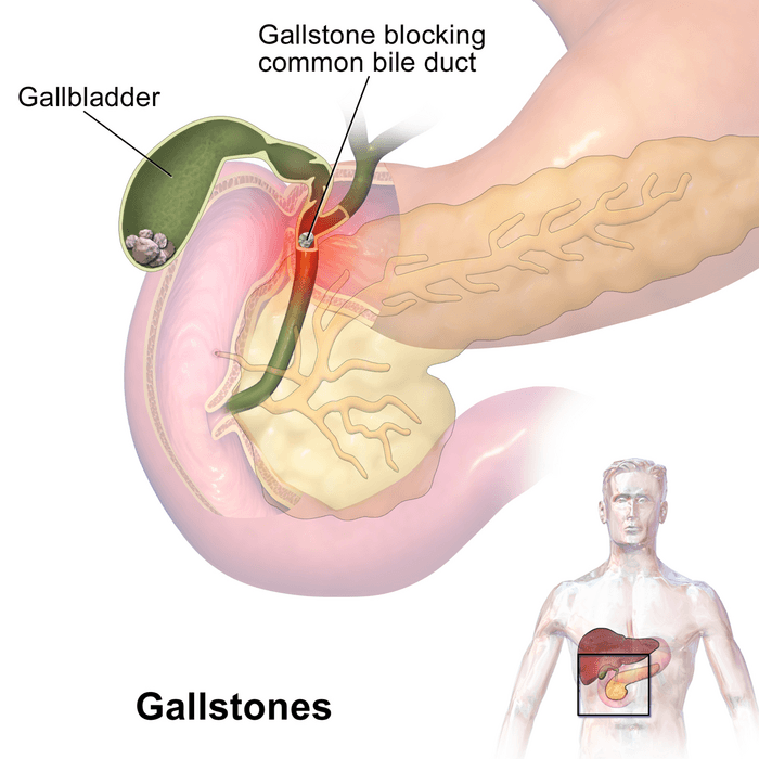Gallstone Removal Surgery In Calgary A Listly List