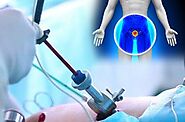 Urologic Surgery - procedure, recovery, blood, removal, pain, adults, time, infection
