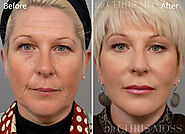 Face Lift & Neck Lift Results - Before and After