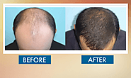 Hair Transplant Sydney? $6,900+GST for 1,500 grafts (FUE) | Dr Daood