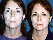 Face lift neck lift plastic surgery in Los Angeles by Aaron Stone MD for a more youthful looking you.
