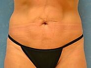 Case 1529- Monclova, OH - Liposuction - Before and After Gallery