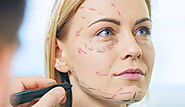 Facelift (Rhytidectomy): What Is It, Recovery & What to Expect