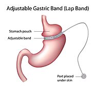 Achieve a Healthier Weight with the LAP-BAND® Surgery in Tijuana, Mexico